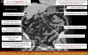 From SIBO to Pancreatic Dysfunction: The Shocking Truth Behind This Patient’s Health Journey