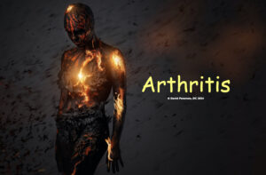 Arthritis